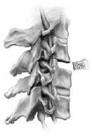 Anterior Cervical Discectomy and Fusion (ACDF) 