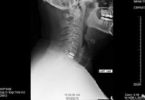 Cervical Disc Replacement 