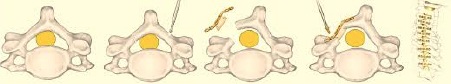 Laminoplasty