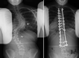 Idiopathic Scoliosis in Children and Adolescents