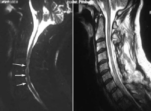 Cervical Spondylotic Myelopathy - MRI 