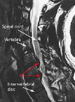 Cervical Spondylotic Myelopathy 