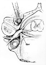 Posterior Cervical Laminoforaminotomy 