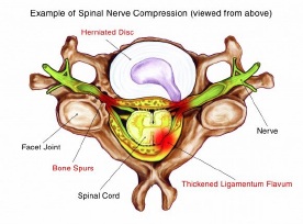 Spinal stenosis 
