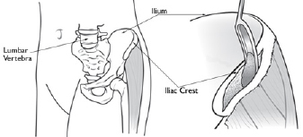 Bone Grafts in Spine Surgery