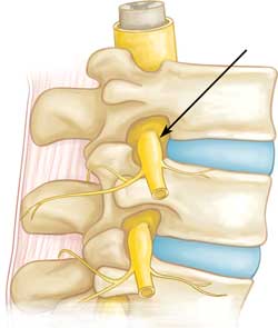 Cervical Radiculopathy (Pinched Nerve)
