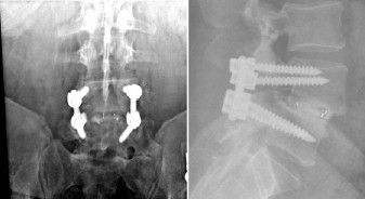  Spinal Fusion Anatomy