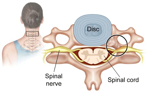 Cervical Stenosis Causes