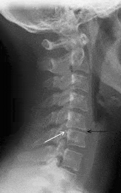 Neck Pain  X-ray